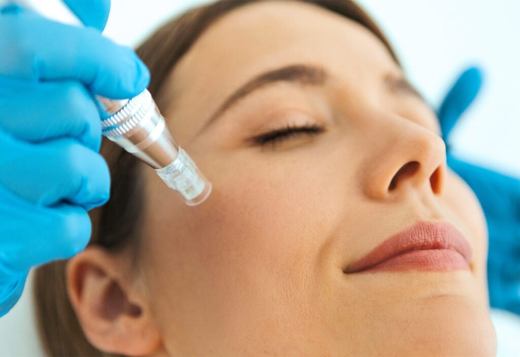 para-que-sirve-mesoterapia-facial